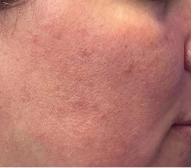 Before the chemical peel