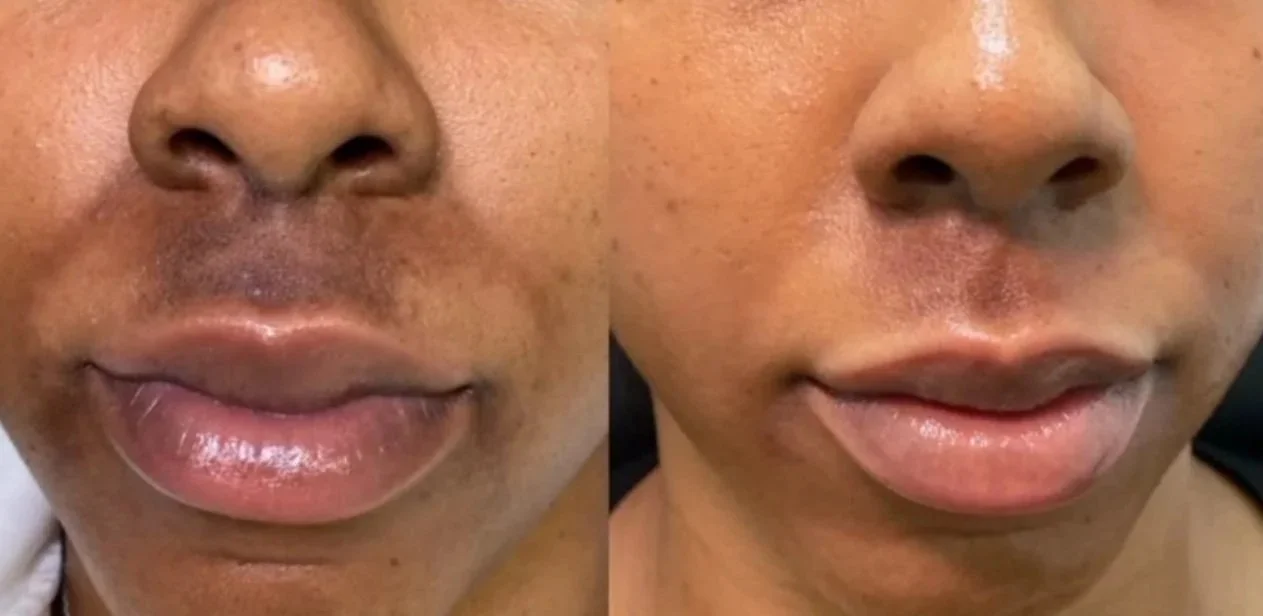 Before and after a series of three chemical peels over 12 weeks.