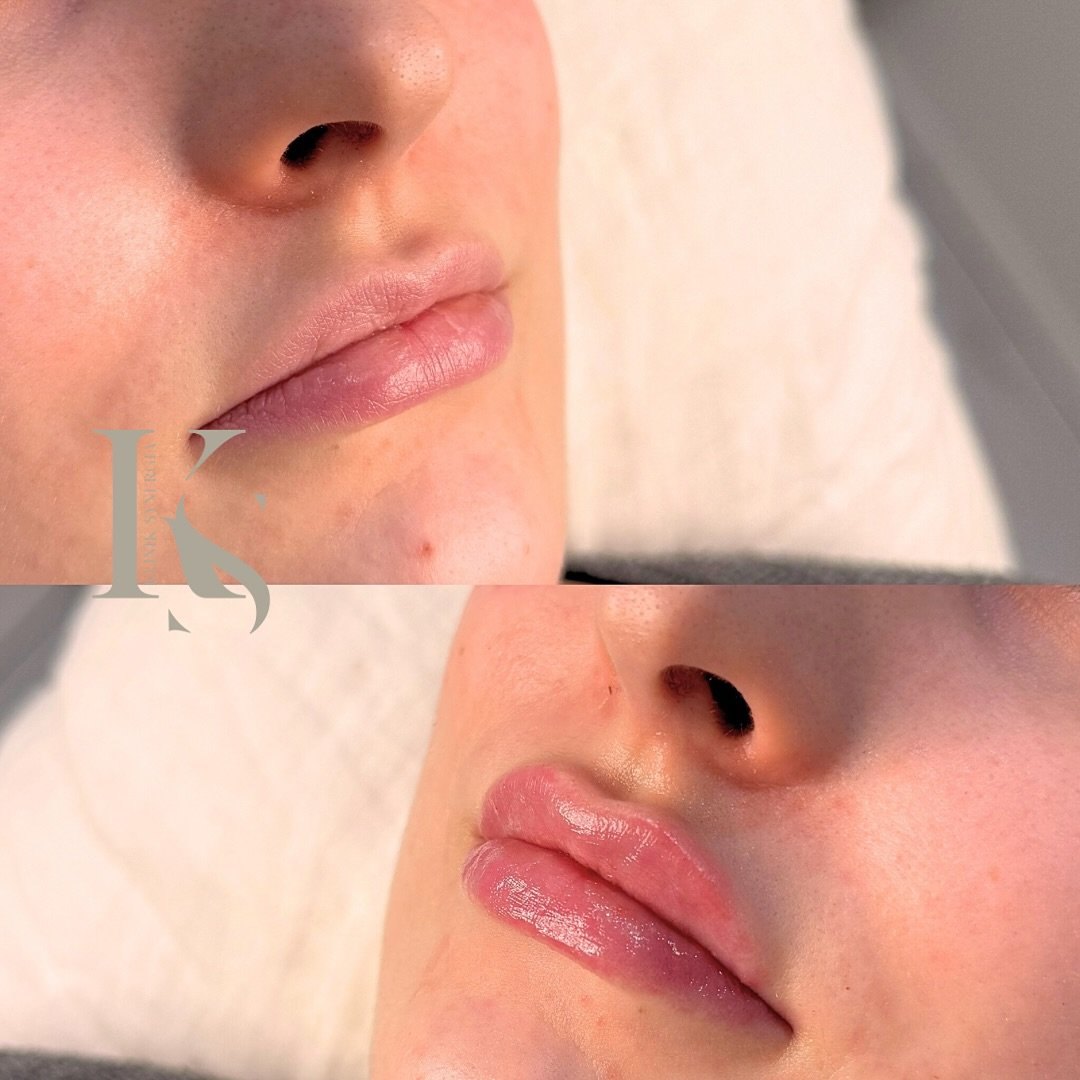 Juvedermin t&auml;yteaineilla saadaan huuliin luonnollisuutta ja pehmeytt&auml;. Klinikaltamme l&ouml;ytyy useampi valmiste juvedermin t&auml;yteaineita huulten muotoilua varten, joilla voimme vaikuttaa huulten volyymin m&auml;&auml;r&auml;&auml;n. 
