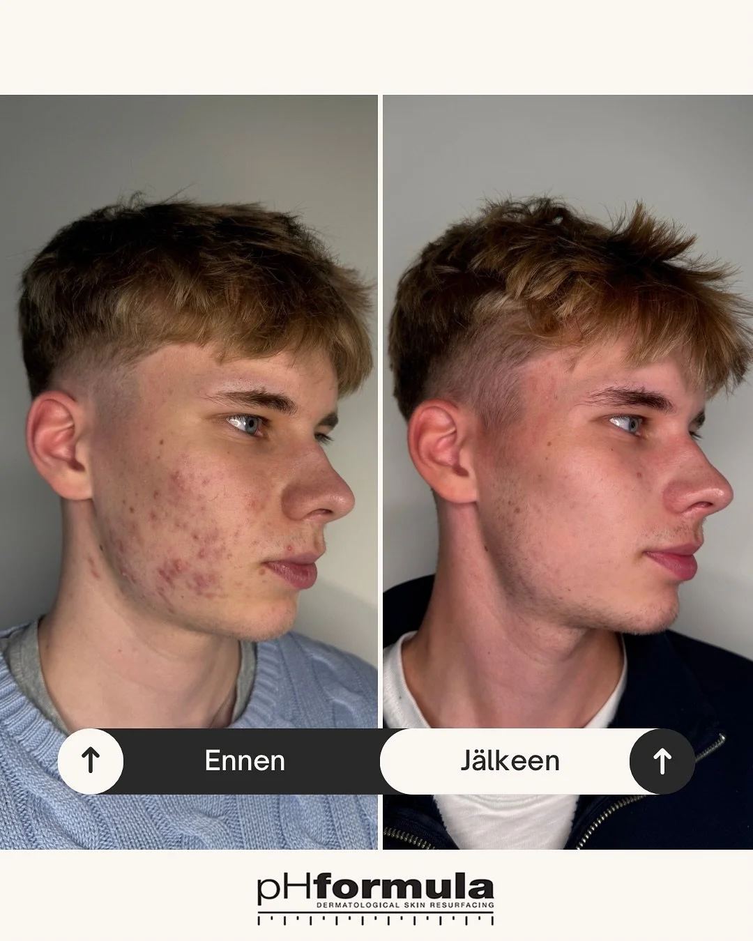 Aknen hoito vaatii malttia ja sitoutumista, mutta se on sen arvoista.

&rdquo;Olen todella tyytyv&auml;inen saamaani hoitoon.
Ensimm&auml;iset hoitokerrat ja hyv&auml; kotihoito kotona alkoi tuottamaan nopeasti tuloksia ja ne huomasin itsekkin hyvin.