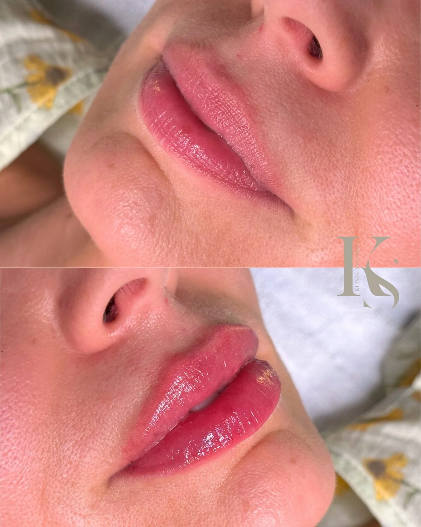 Huulten syv&auml;kosteuttava hoito, kiinteytt&auml;&auml; ja kirkastaa huulia, v&auml;hent&auml;&auml; kuivuutta ja hienoja juonteita, parantaen huulten kuntoa ja ulkon&auml;k&ouml;&auml;. Hoito ei lis&auml;&auml; huuliin juurikaan volyymia, vaan kes