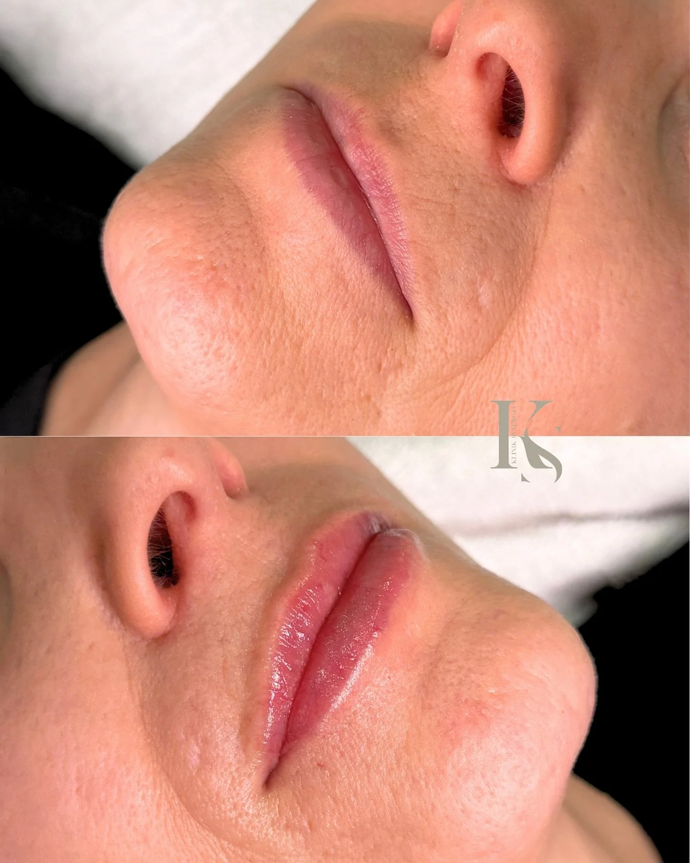 Huulten muotoilu &ndash; yksil&ouml;llisesti ja vastuullisesti

Meille huulten muotoilu on paljon enemm&auml;n kuin vain t&auml;ytteen lis&auml;&auml;mist&auml;. Kyse on tasapainosta, estetiikasta ja siit&auml;, mik&auml; sopii juuri sinun kasvoilles