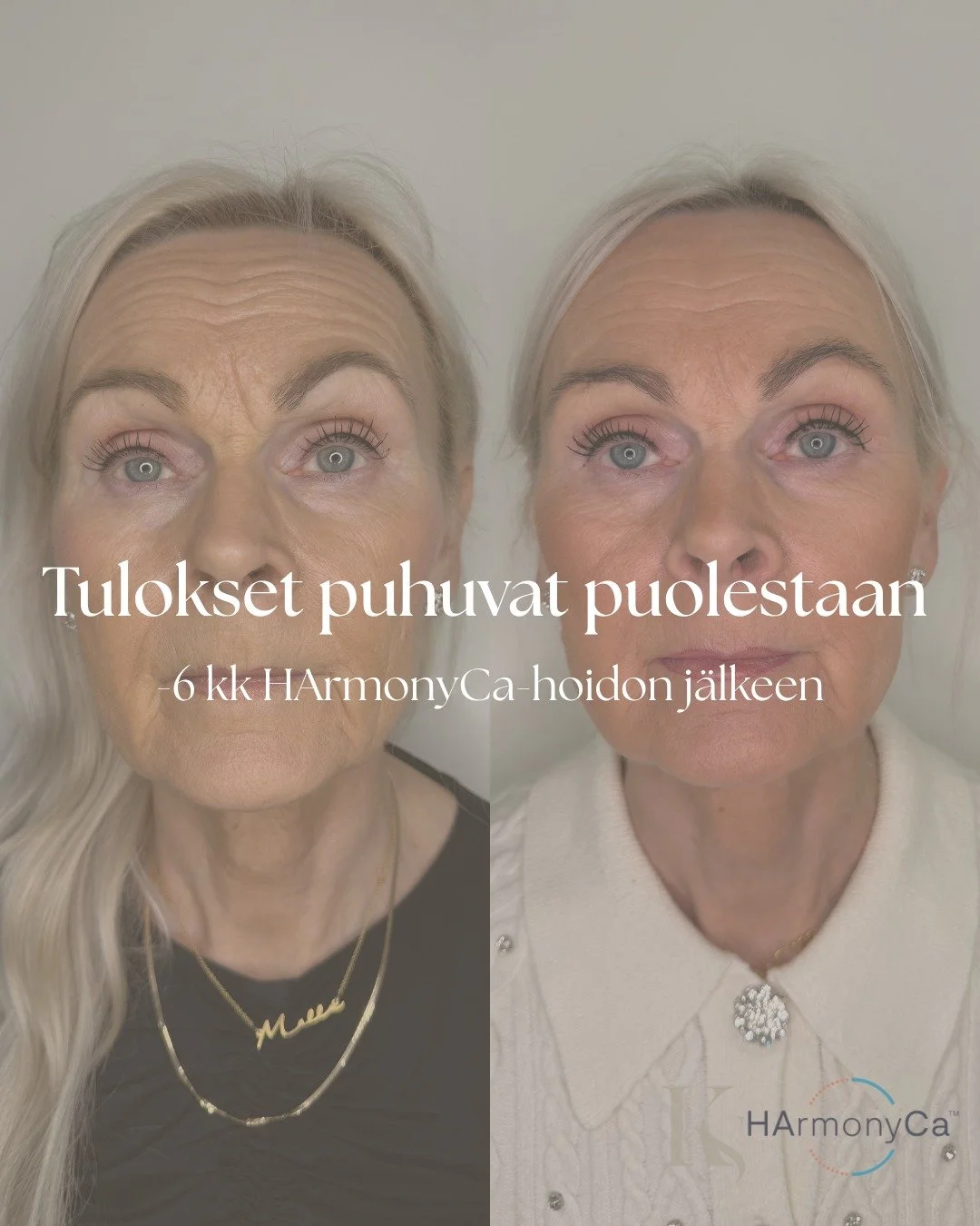 Miksi valita HArmonyCa&trade;-hoito?

HArmonyCa&trade; on ainutlaatuinen hybridi-injektiohoito, joka yhdist&auml;&auml; hyaluronihapon v&auml;litt&ouml;m&auml;n kosteuttavan ja t&auml;ytel&auml;ist&auml;v&auml;n vaikutuksen sek&auml; kalsiumhydroksia