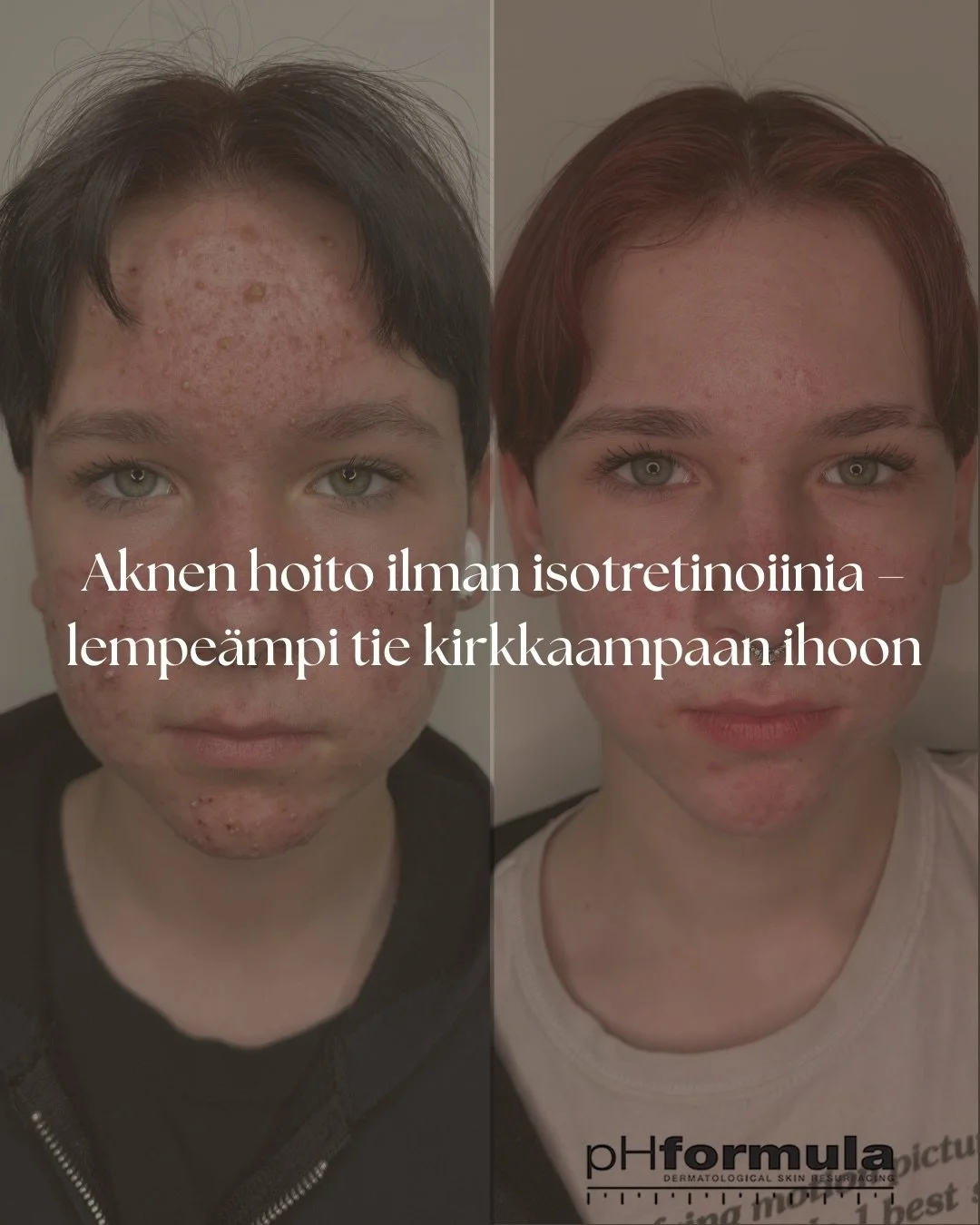 Mik&auml; on akne?

Akne on ihosairaus, jossa talintuotanto, tukkeutuneet ihohuokoset, bakteerit ja tulehdusreaktiot aiheuttavat n&auml;ppyj&auml;, finnej&auml; ja kysti&auml;. Akne ei ole vain teini-ik&auml;isten vaiva &ndash; sit&auml; esiintyy yh&