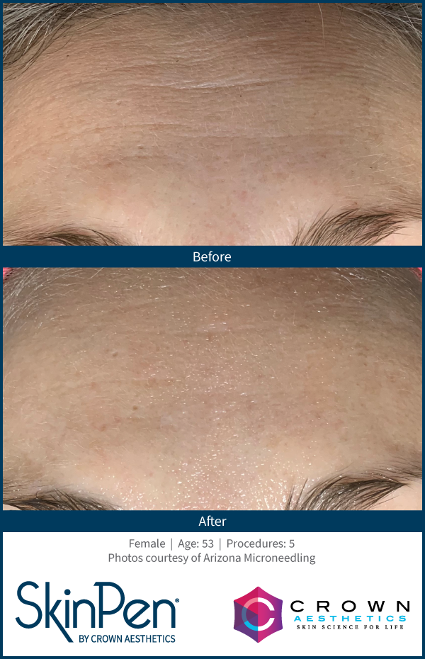 BA-SkinPen-FLAW-LG-Forehead-ArizonaMicroneedling-5treatments-53YO.png