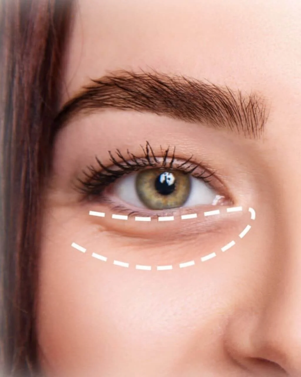 Silmänympärys-hoidot – tummuuden, ryppyjen ja juonteiden, kirkastava hoito | Klinik Synergia Lahti