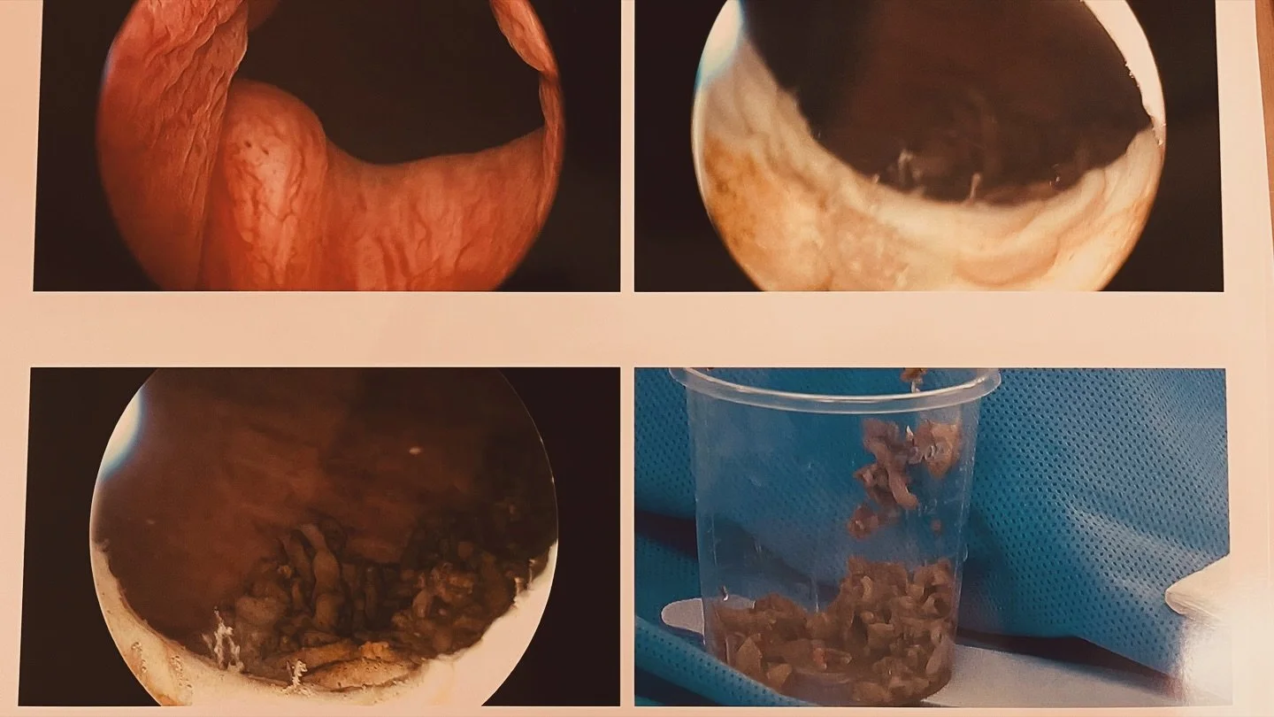 Never gets old:#TURP #BPH #prostate