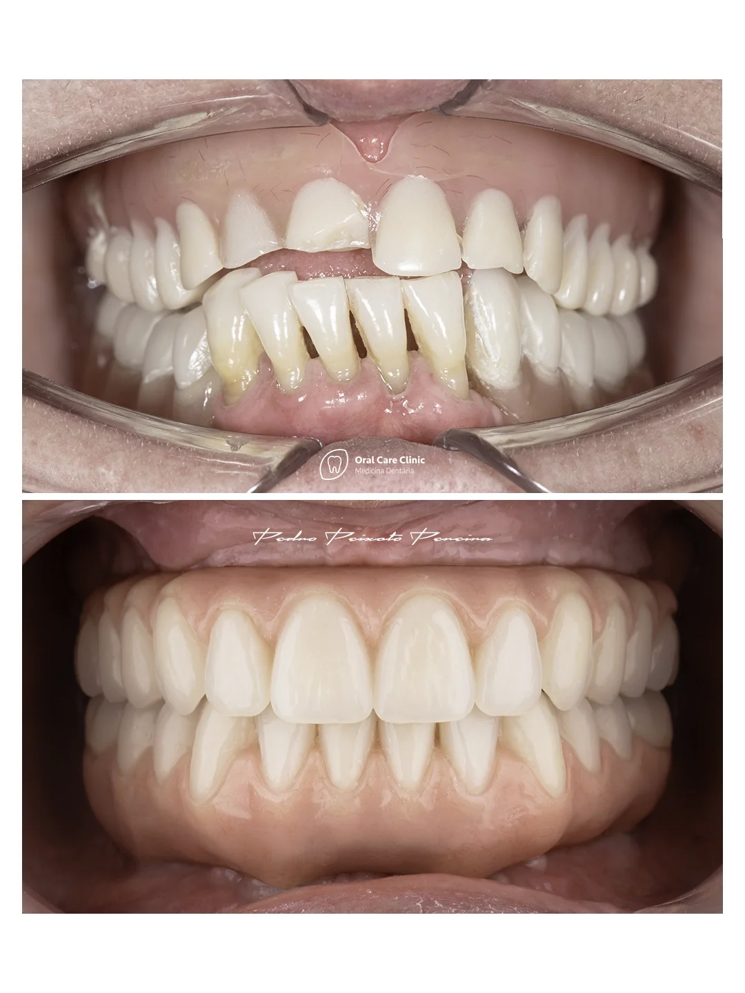 Implantes_Dentarios_2.webp