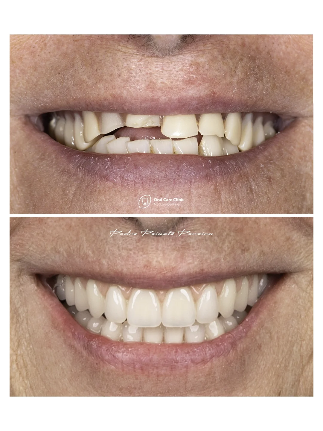 Implantes_Dentarios_2_1.webp