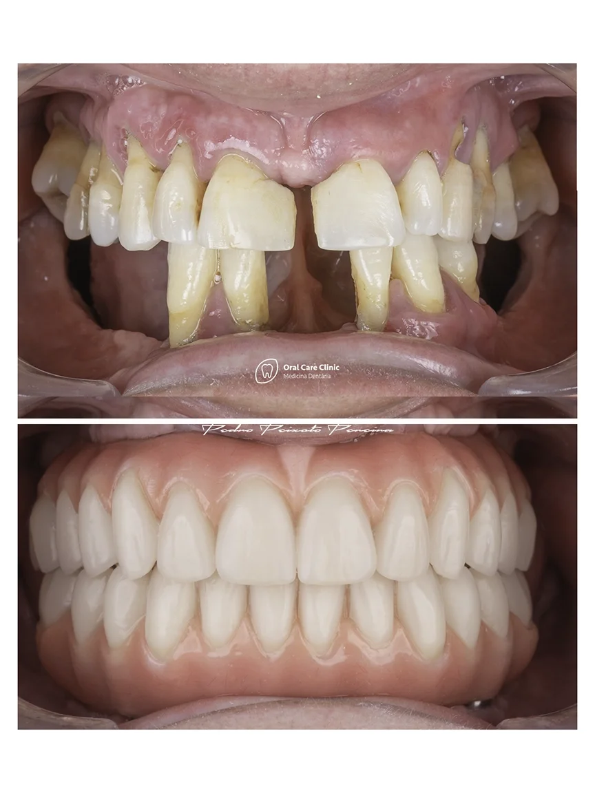 Implantes_Dentarios_1_1_S.webp