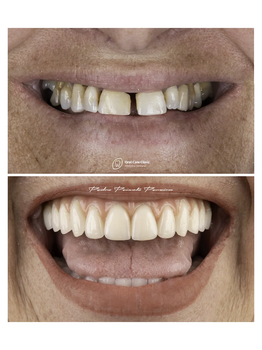 Implantes_Dentarios_1_S.webp