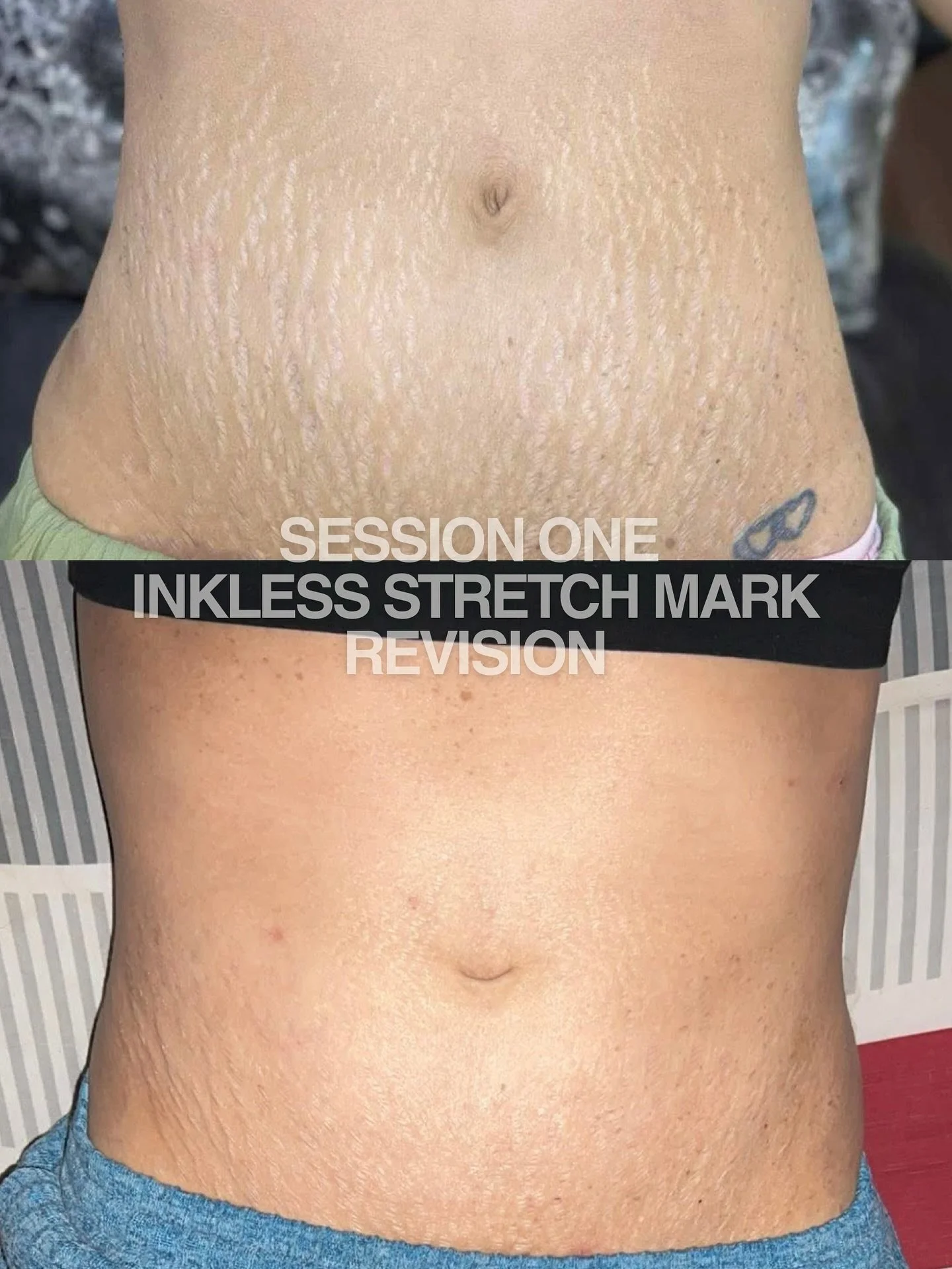 This is hands down my favorite service right now only because I&rsquo;ve waited a long time to see results this fast and effective, not only for my clients, but as a mama who has them too!

These results are after just ONE session of ISR and we are b