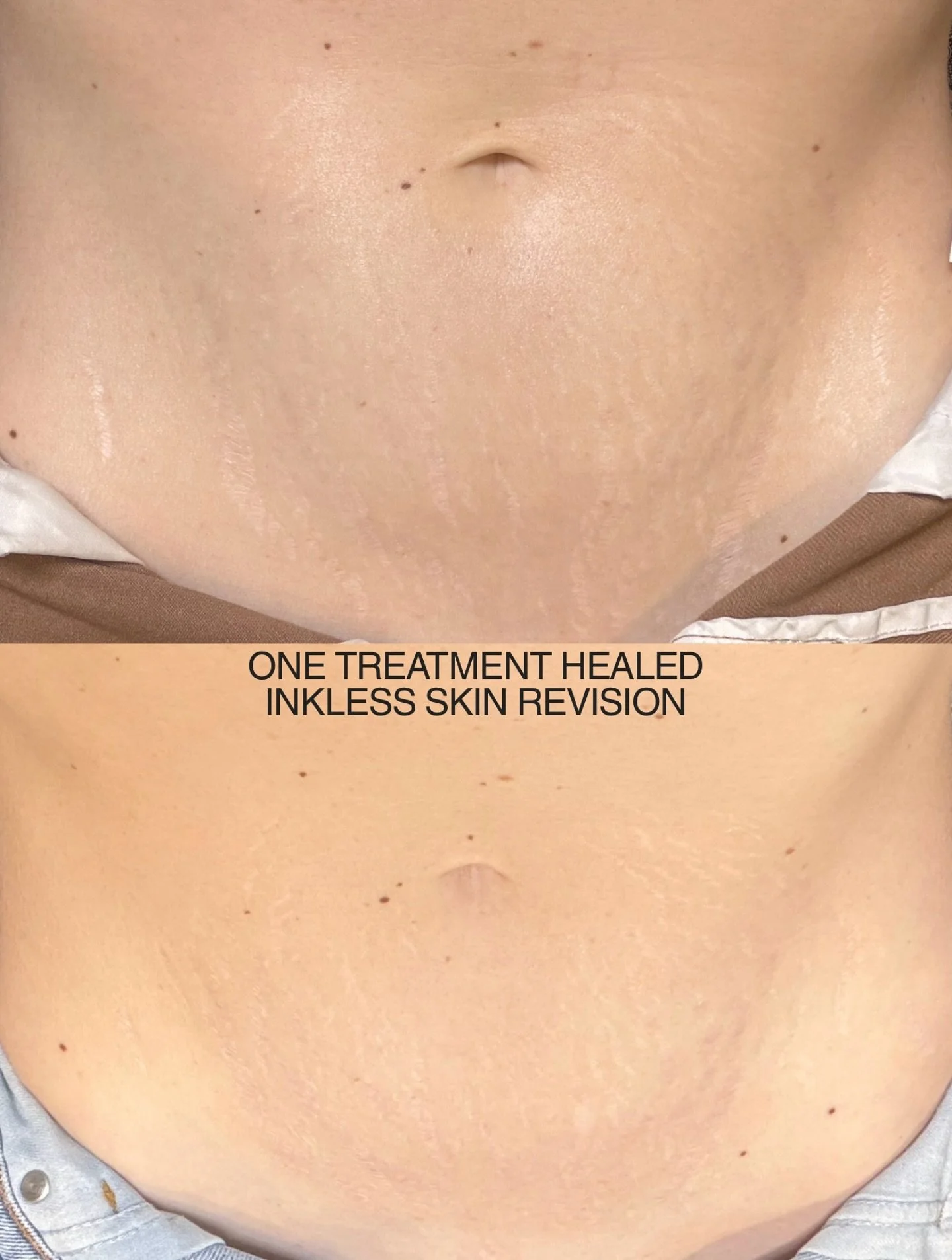 ONE SESSION 🤯
Even after one treatment, the difference is clear — the stretch marks look more natural and less noticeable. The edges begin to soften and the tone starts to blend more evenly.
And this is only the beginning 🪄
Treatment: Inkl