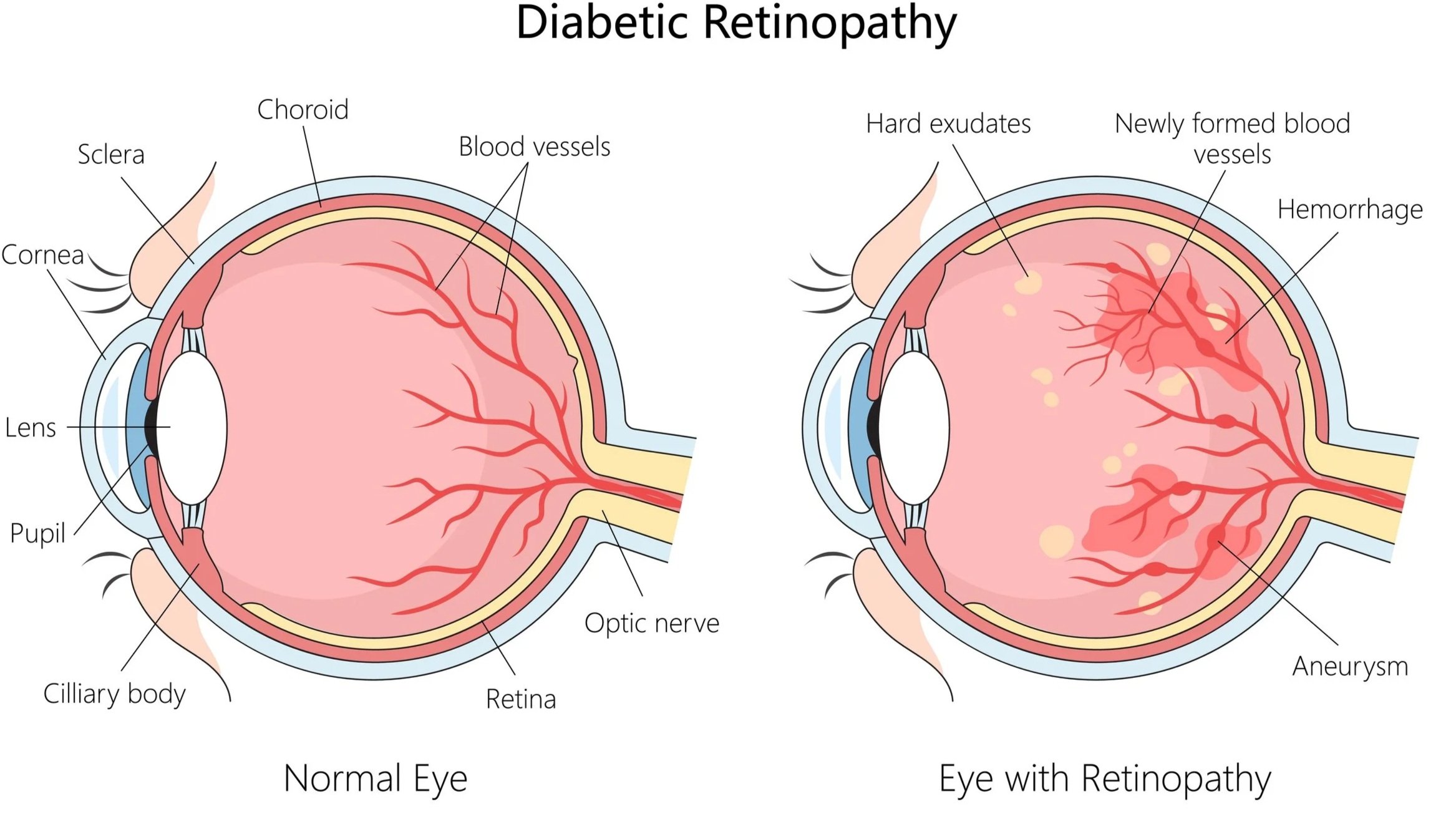 Diabetic Retinopathy: Understanding the Silent Threat to Your Vision