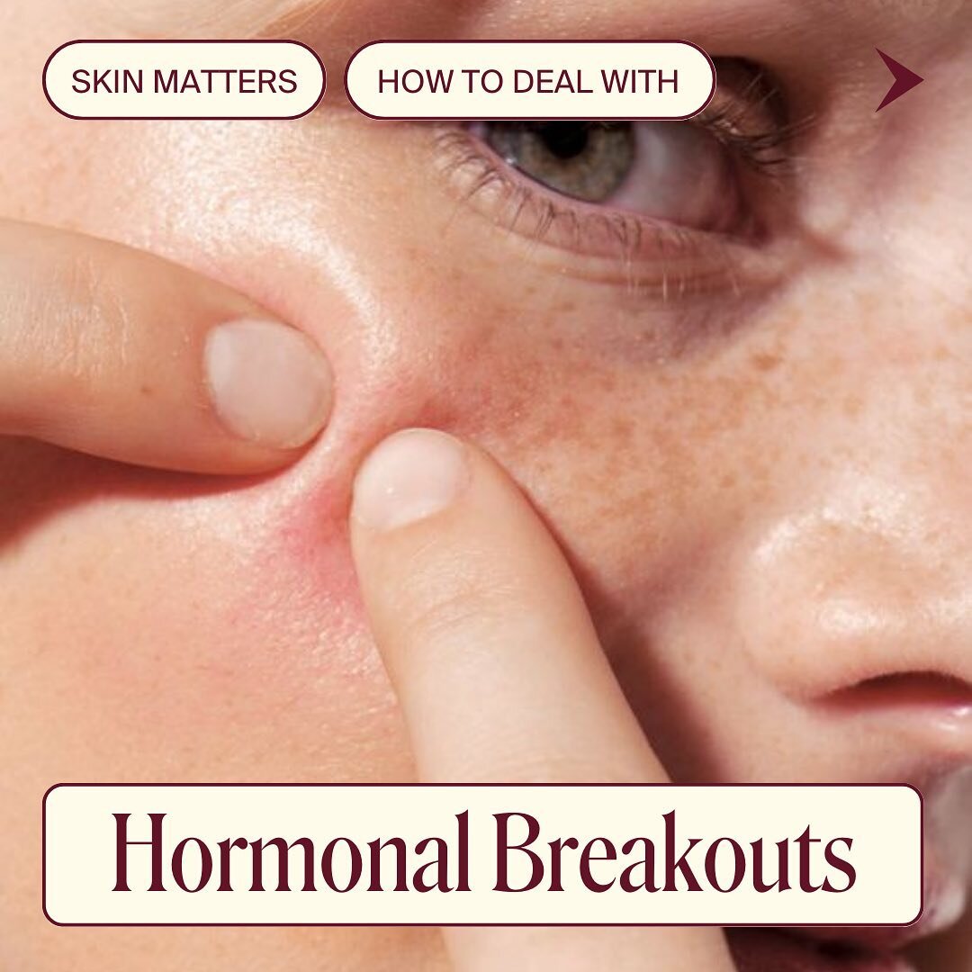 Suffering from hormonal acne? You&rsquo;re not alone.

Our Resident Dermal Clinician, Sally Grant, shares her expert tips to heal troublesome skin.