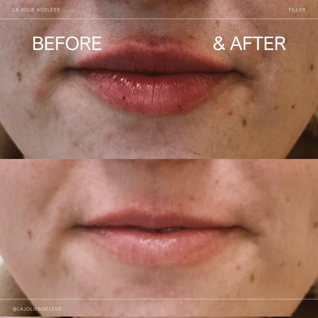 This is your sign to book your lip appointment ✨ We used about 1/2 a syringe here! 

#LipFillerTransformation #BeforeAndAfter #NaturalEnhancement #EnhancedLips #FirstTimeFiller #PlumpLips #SubtleEnhancement #YouthfulAppearance