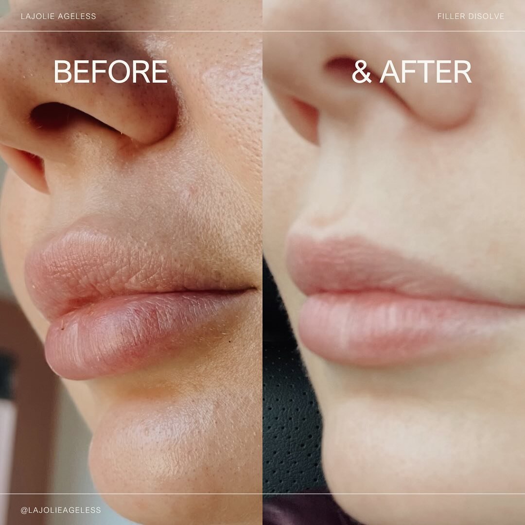 Disolving lip filler before &amp; after ✨ We disolve filler for a multitude of reasons but if you&rsquo;re looking for a certified place to discolve your filler, we&rsquo;ve got you!

Book Online
www.lajolieaa.com

#injector #lipfiller #botox #beauty