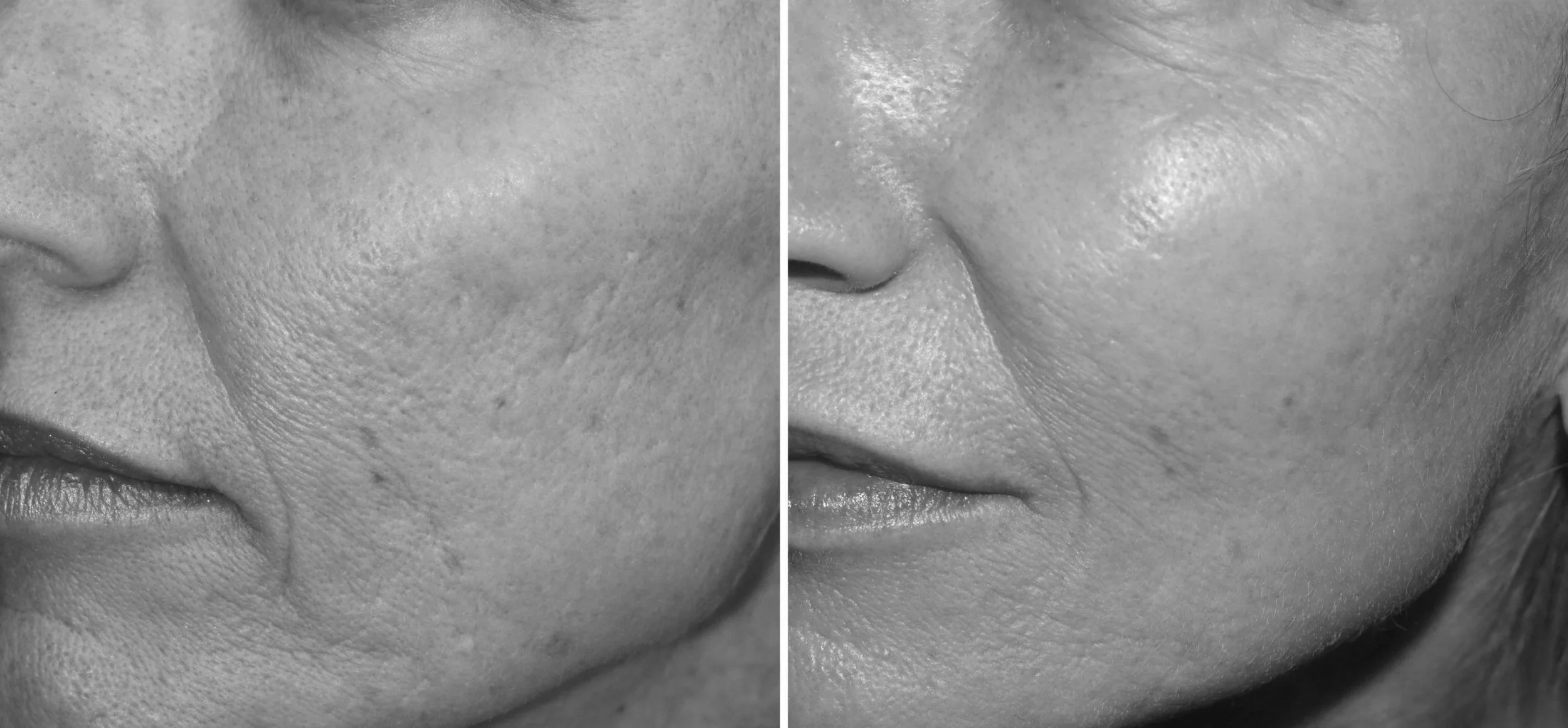 Chemical Peels