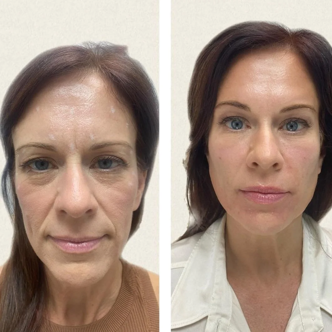 PRP Injections
