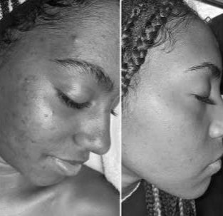 Facials