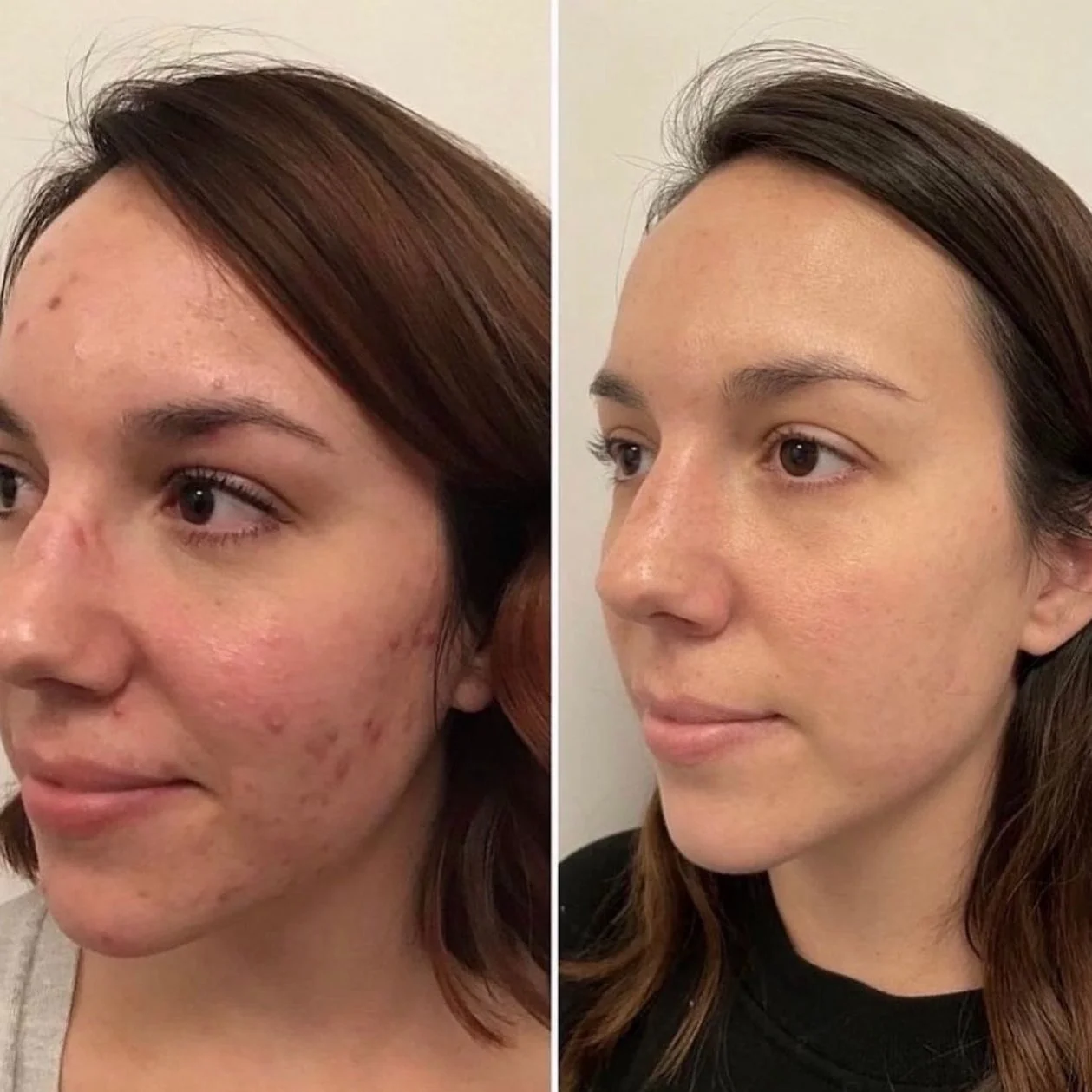 chemical peel
