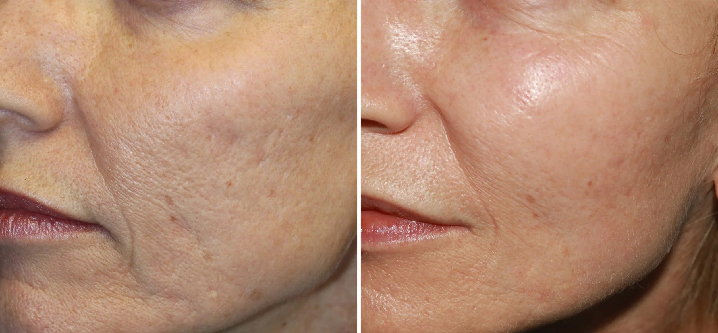 Microneedling
