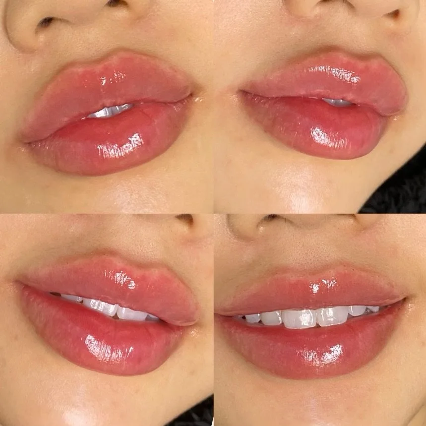 Lip Injections