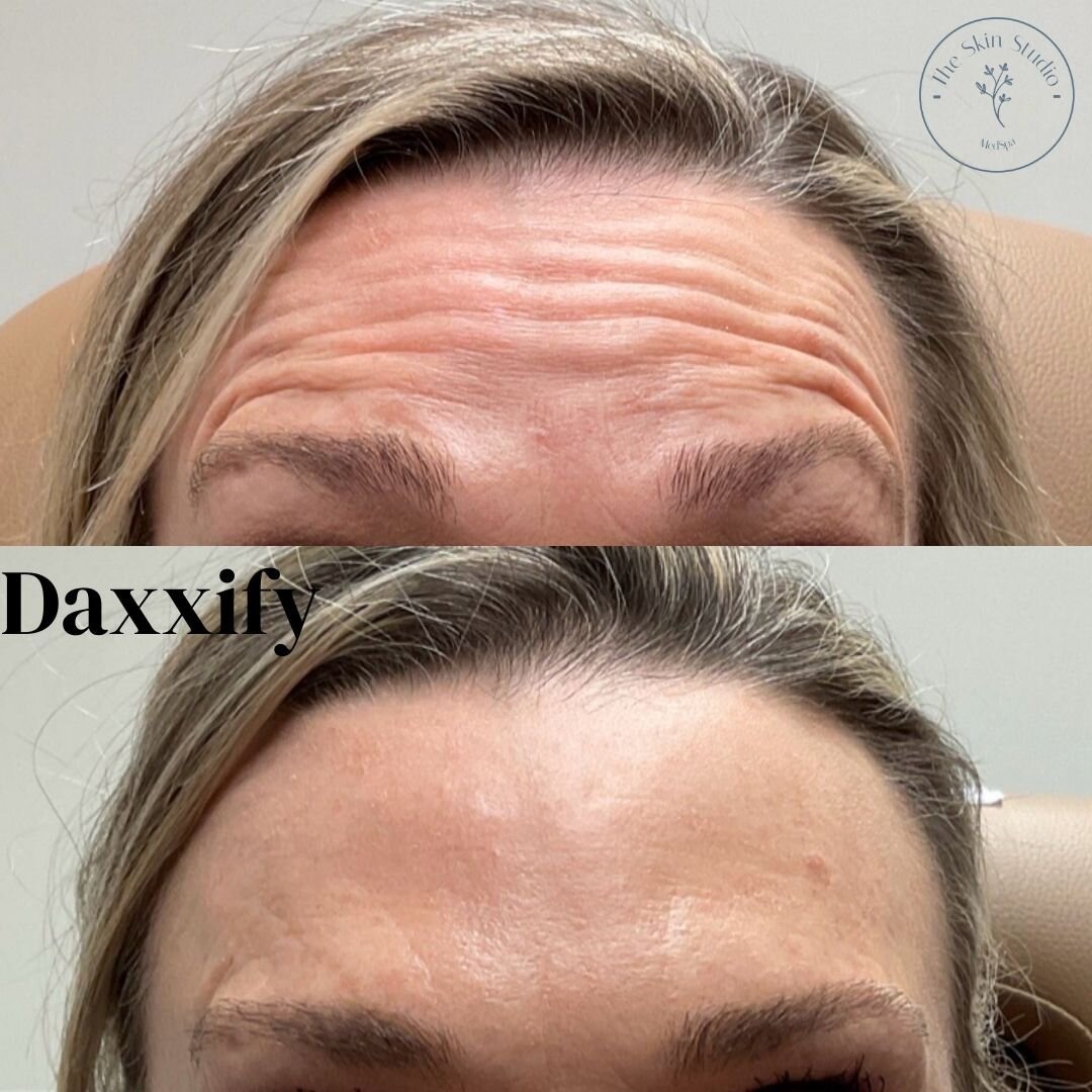 Look at this transformation!!!!

Daxxify was used to smooth this lovely client's forehead lines. She is super pleased with her treatment!

One huge benefit of Daxxify....it starts working in 48 hours (for most clients). Talk about FAST results!!!

Th