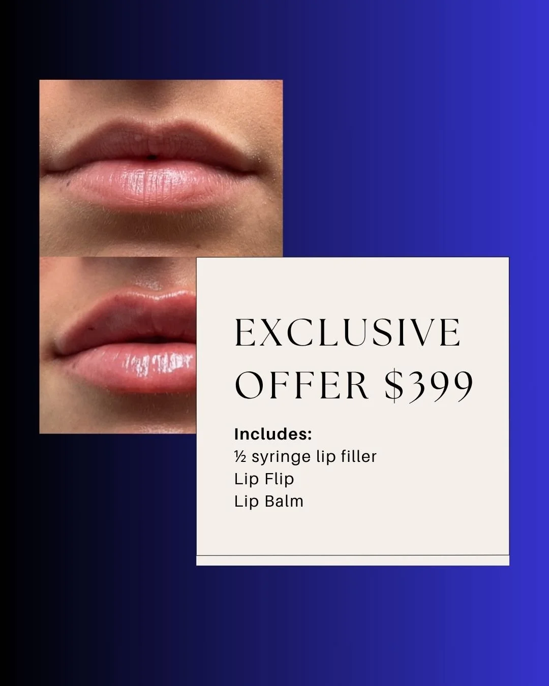 💋 The Ultimate Lip Bundle &ndash; Just $399! 💋
For a limited time, get:
✨ &frac12; Syringe Lip Filler
✨ Lip Flip
✨ Hydrating Lip Balm

Perfectly plumped, subtly defined, and soft-as-silk lips &mdash; all in one exclusive offer! 💉💄

📅 Book now &m