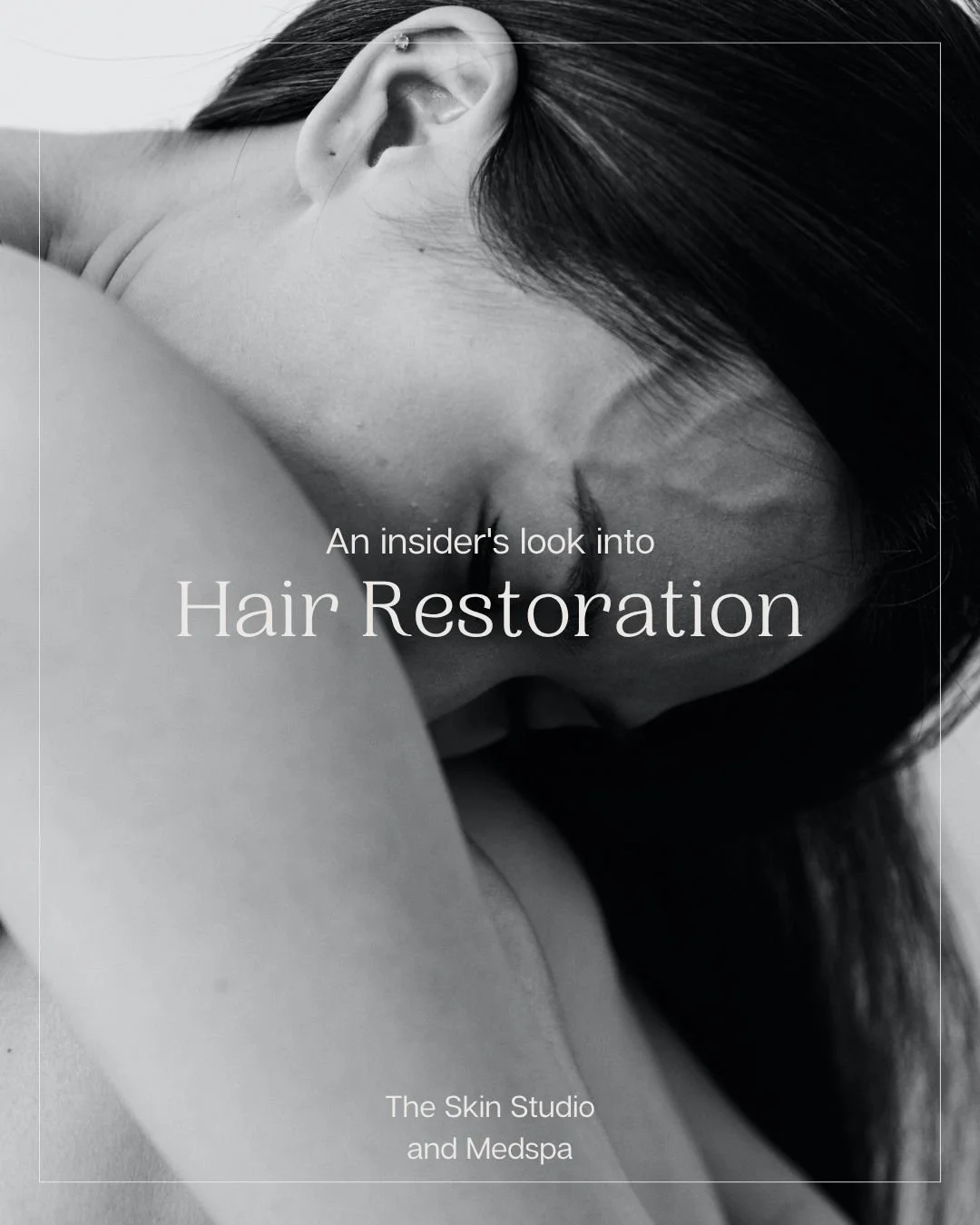 🧬 August is Hair Loss Awareness Month &mdash; and if you&rsquo;ve noticed thinning, shedding, or a widening part&hellip; you&rsquo;re not alone.

✨ Meet Alma TED &mdash; a revolutionary, needle-free treatment that uses sound waves and air pressure t