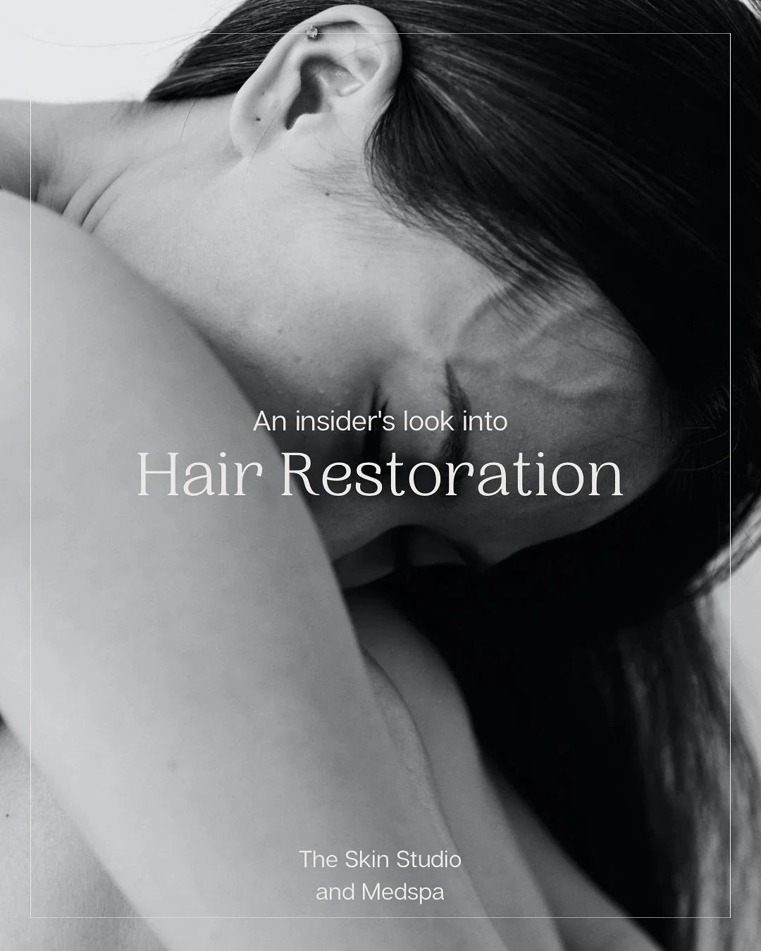 ✨ Fuller, healthier hair is possible without needles, pain, or downtime! ✨
With Alma TED Hair Restoration, we use sound waves + air pressure to deliver growth factors directly to your scalp &mdash; no trauma, no shedding, just results. 🌱

✅ Boosts h