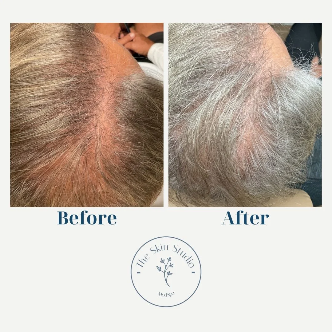 Comparison of scalp hair before and after treatment, showing increased hair density and reduced scalp visibility on the after side, with the logo of The Skin Studio at the bottom.