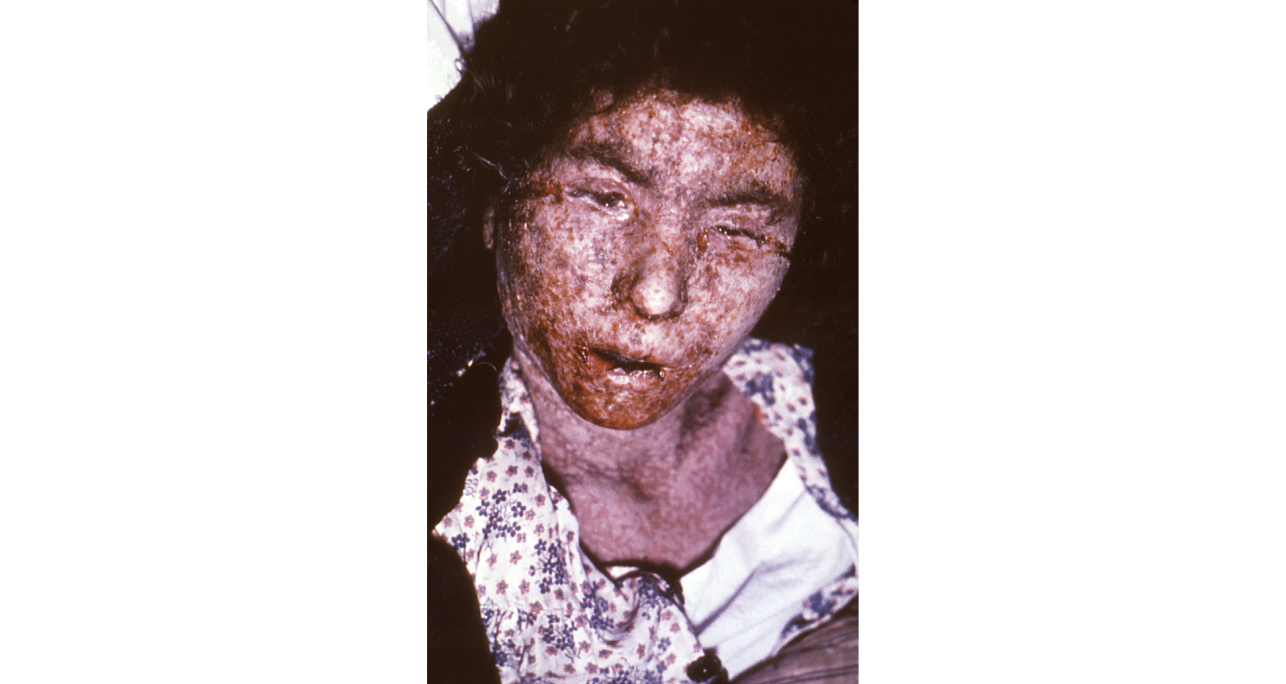 A female smallpox victim from Italy in 1965