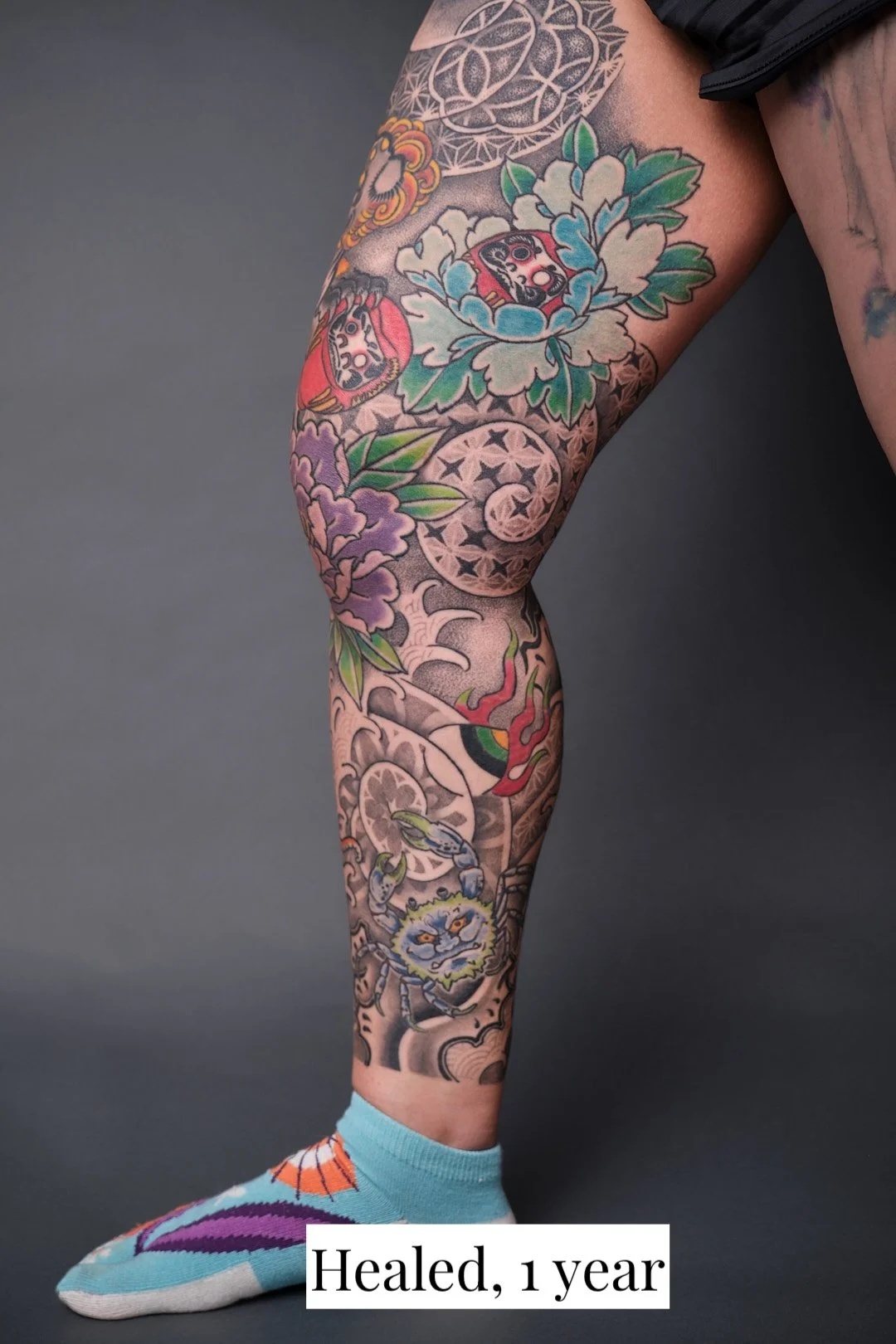 Mixed style leg sleeve, 1 year healed