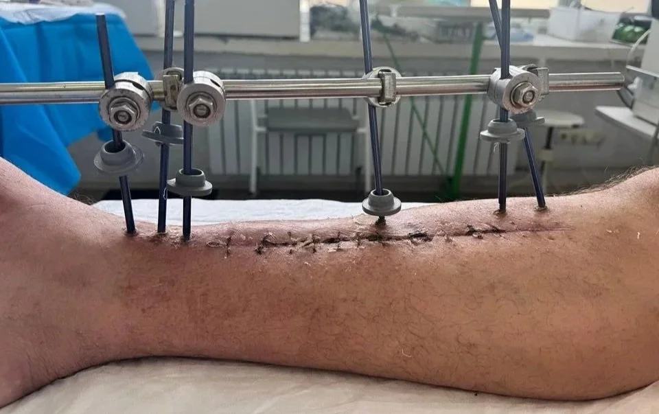 100 More Reasons for Hope: Limb-Saving Devices Delivered to Dnipro 💪🏻💙