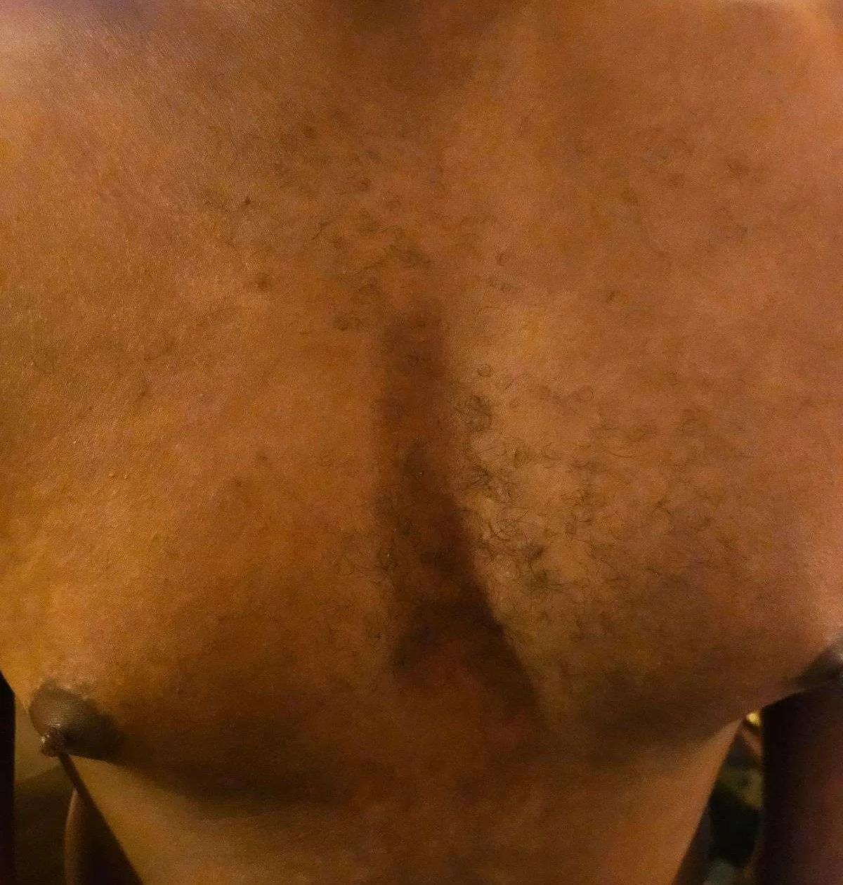 Keloid Scar Application Before.jpg