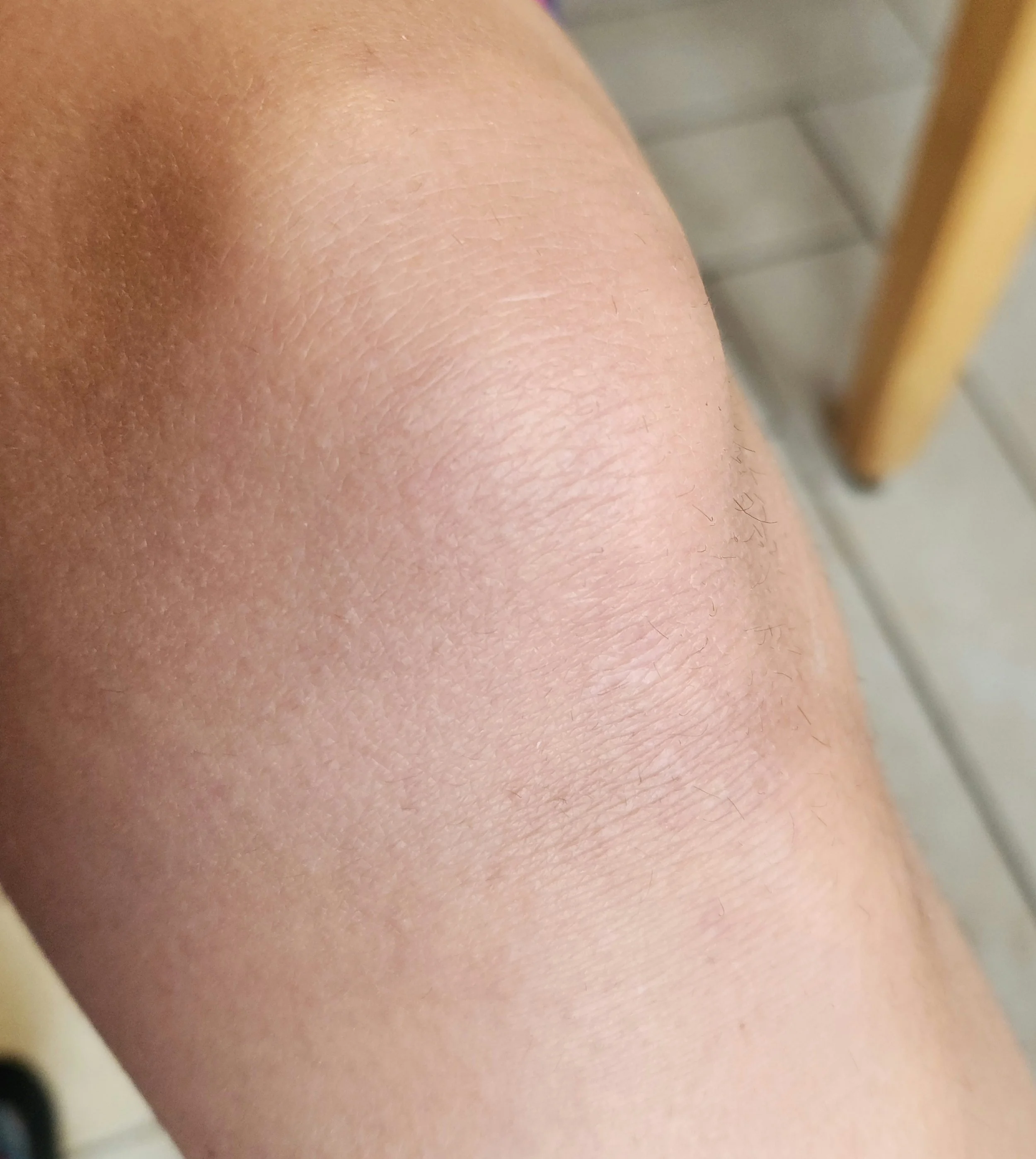 Scab on knee Before.jpg