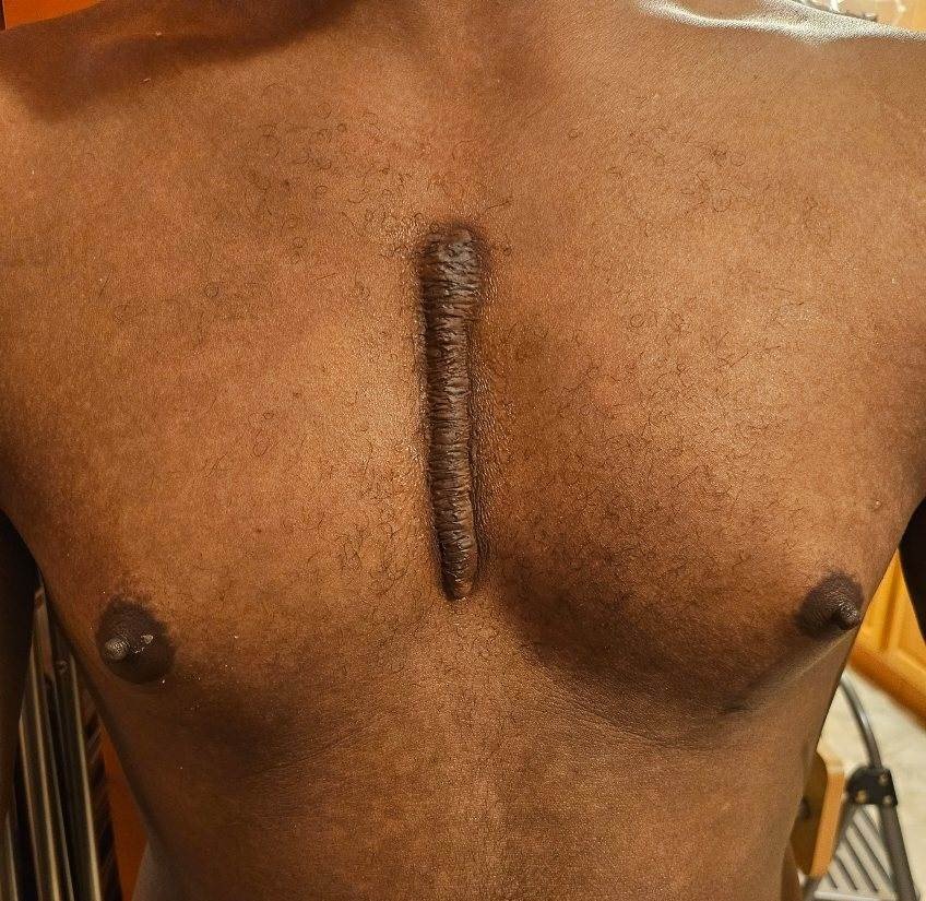 Keloid Scar Application After .jpg
