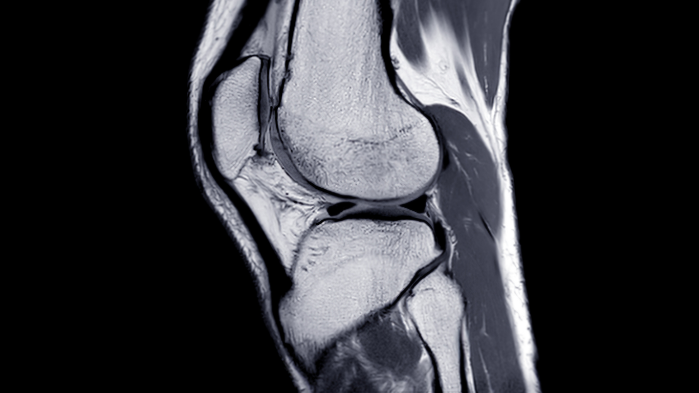 Five Ways to Protect Your ACL and Stay Active in Colorado