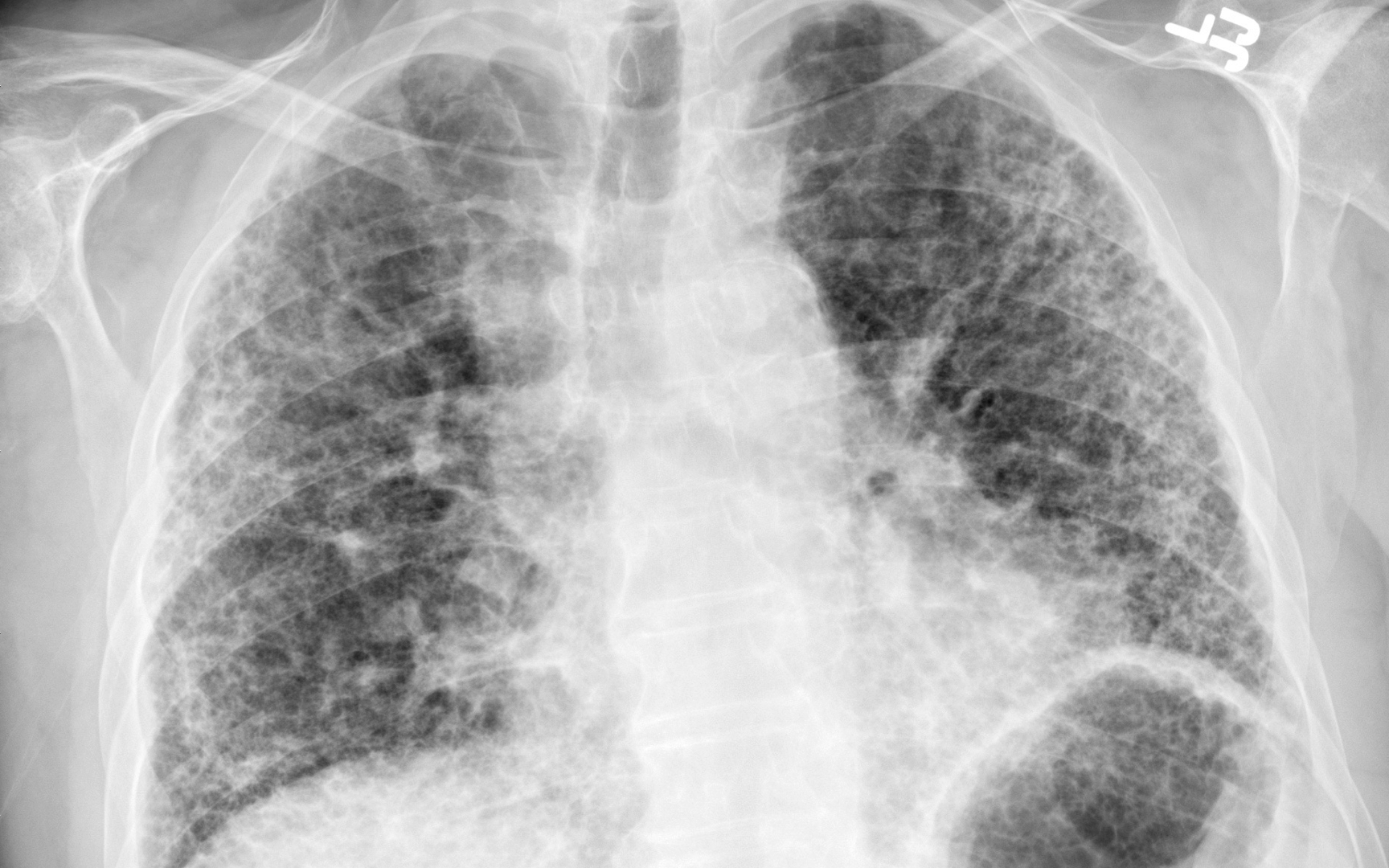 9. Reticular & Septal Interstitial Patterns — Radiology Slides
