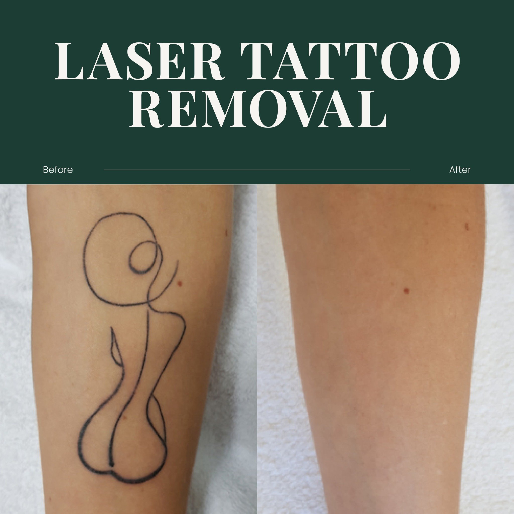It&rsquo;s no secret that we love Laser Tattoo Removal 🙌

There&rsquo;s just something about it that we find so satisfying 😍

Whether it's a faded design or a full cover-up, our advanced laser technology delivers real results! 

Ready to start your