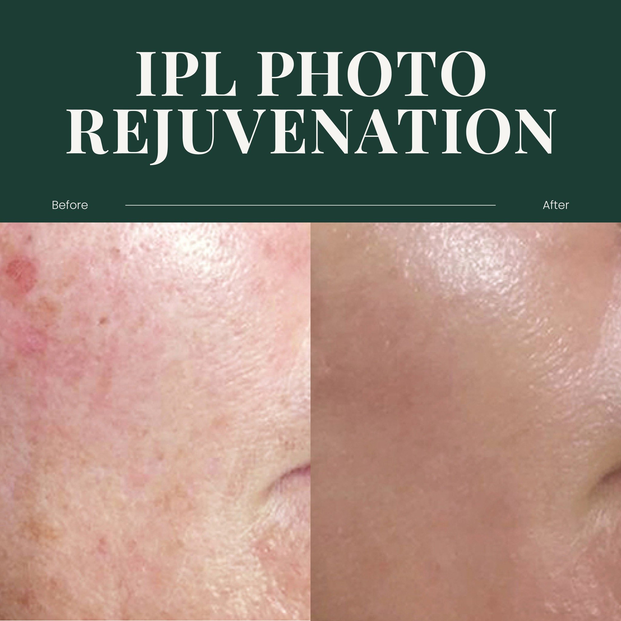 ✨ Before &amp; After: IPL Photo Rejuvenation ✨

Check out these amazing results from our IPL Photo Rejuvenation treatment! 🙌 

This non-invasive procedure helps reduce pigmentation, redness, and signs of aging, leaving the skin looking smoother, cle