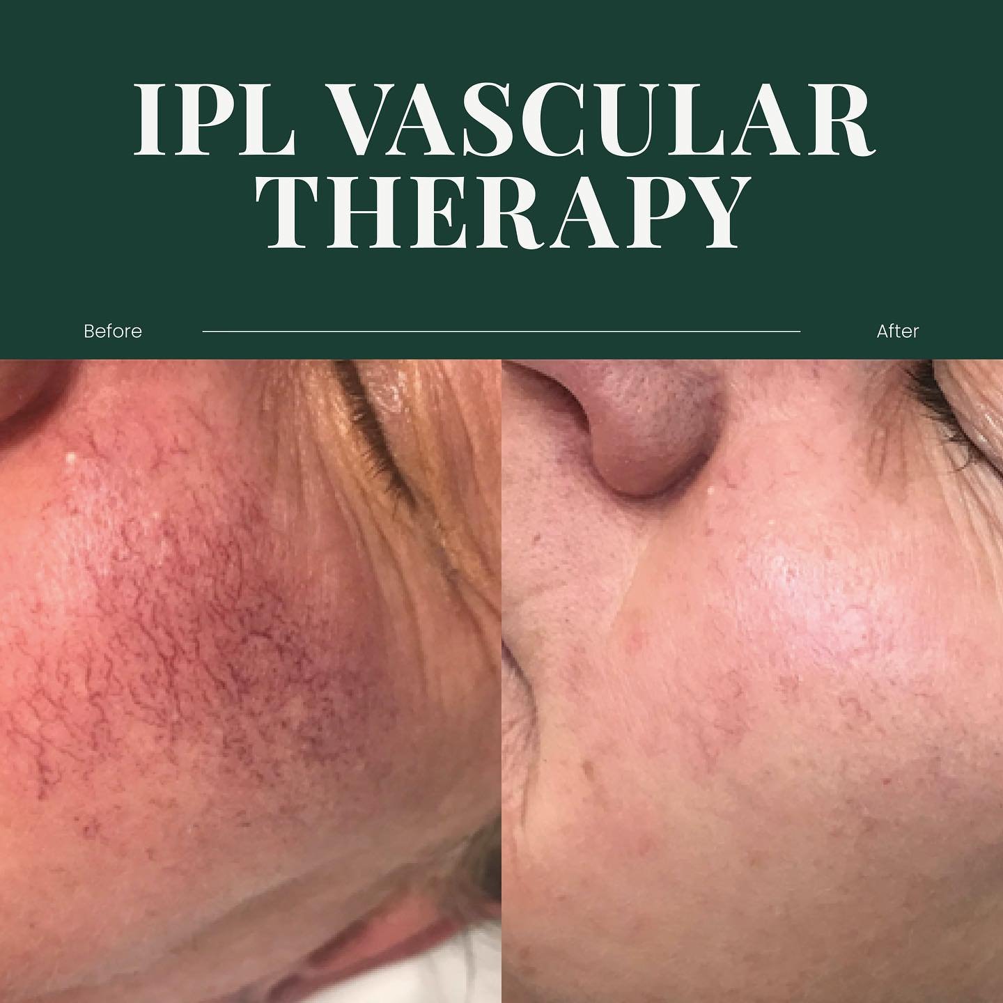 ✨ Before &amp; After: IPL Vascular Therapy ✨

We&rsquo;re all about results here at Aphra Aesthetics, and this transformation speaks for itself! 🙌

Our IPL Vascular Therapy is designed to target broken capillaries, redness, and uneven skin tone, lea