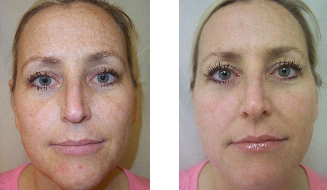 dermafrac_comp4.jpg