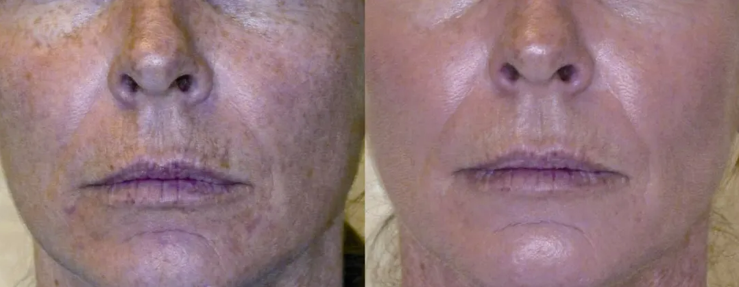 Chemical peel 2.png