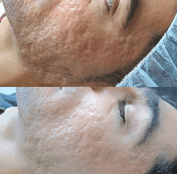 Needling before & after.png