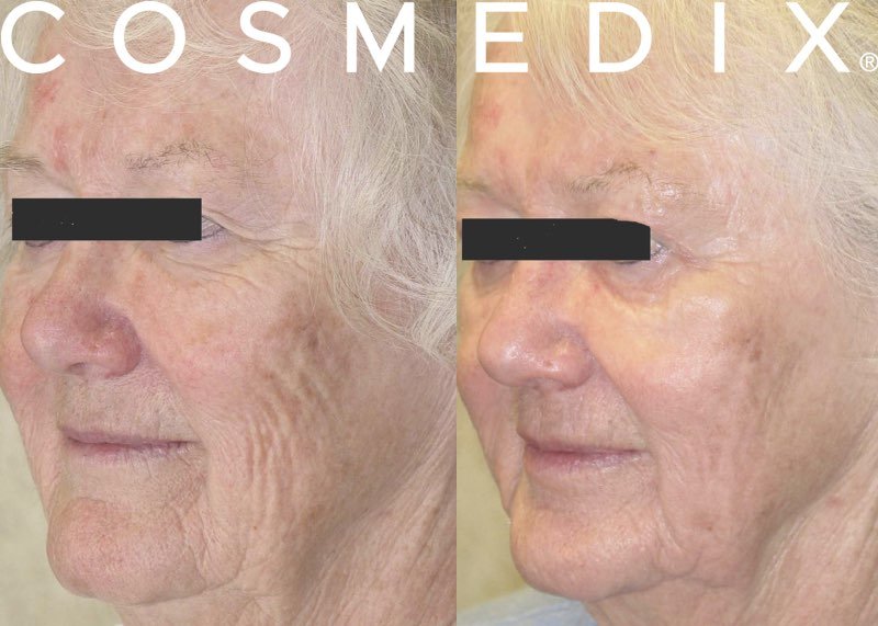 Chemical Peel before & after.jpeg