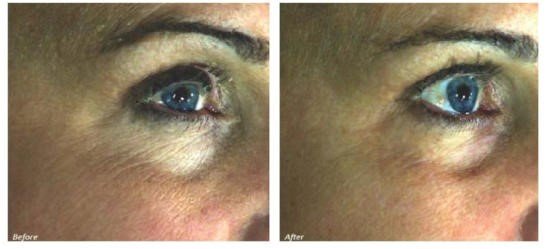 Dermafrac 1.jpg