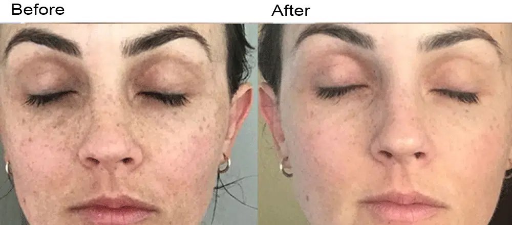 Dermafrac 2.jpg