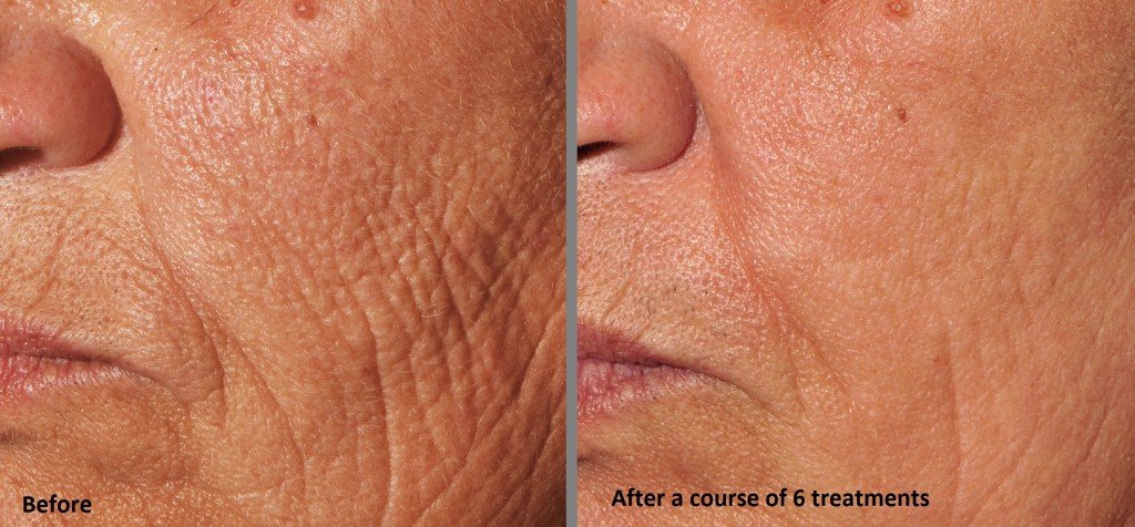 DermaFrac-.jpg